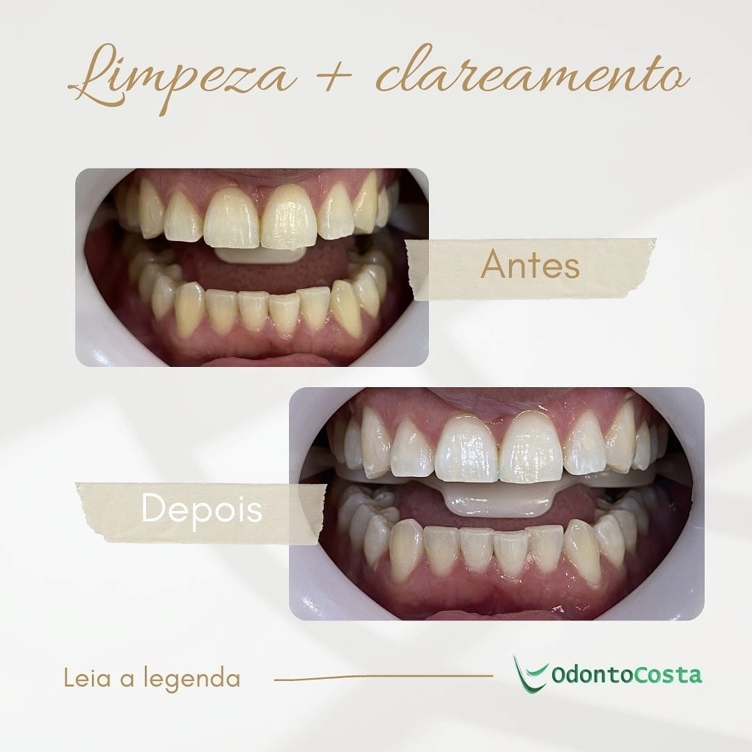 Antes e depois – Limpeza + clareamento