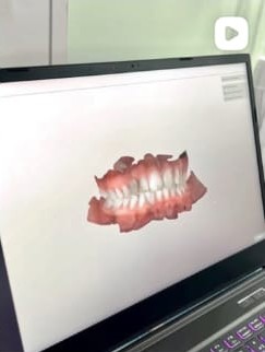 Escaneamento digital intraoral exibido em notebook